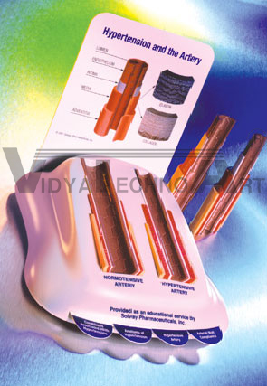 Hypertension Model
